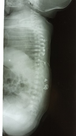 Lateral abdominal x-ray showing the defected vertebra.