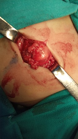 Dissection stage of the hernial sac.