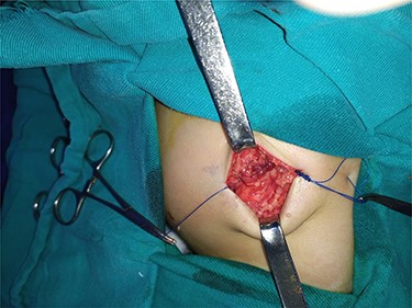The consolidation stage after reduction of the hernia sac of the abdominal cavity.