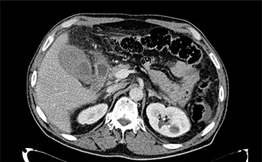 Abdominal CT scan showing the gallbladder with high-density contents.