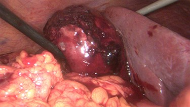Intraoperative evidence of hemorrhagic cholecystitis.