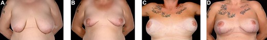 39-year-old with a history of severe breast asymmetry and mild tuberous breast deformity (A) corrected in two stages (left breast reduction and right mastopexy (B) followed by bilateral subpectoral augmentation 1 year later). This was complicated by left implant rupture and bilateral Baker III capsular contracture for which she underwent bilateral capsulectomies and implant exchange. The patient subsequently developed hypermobile implants with lateral displacement, a wide intermammary distance, and no cleavage (C) requiring Wise pattern mastopexy and exchange for smaller 370 and 325 cc (as former 590 and 525 cc could not be totally covered by the Braxon® ADM) implants with total Braxon® ADM coverage (D) which was secured to the chest wall with 2/0 PDS. Prior to Braxon®, a very wide intermammary distance (and loss of IMF definition) (C) due to stretched tissues following massive weight loss and combined with very large implants (subglandular implant position) can be seen.