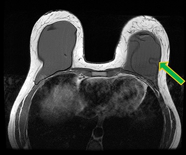 Ruptured left breast implant on MRI as demonstrated by the linguine sign (indicated by green arrow).