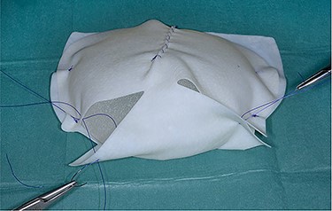 Braxon®-ADM totally wrapped around a fixed volume implant prior to insertion into the implant pocket.