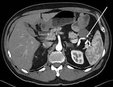 Axial CT scan of abdomen, selected image from a pancreatic protocol. Early arterial phase during which there is opacification of the arterial structure (arrow).