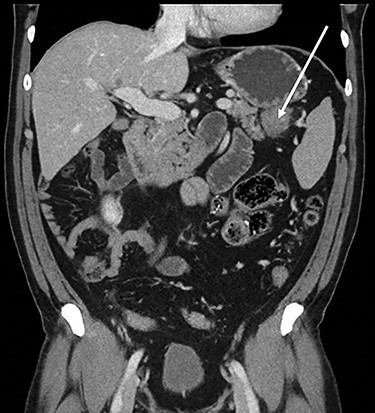 Coronal CT scan of abdomen, selected image from a pancreatic protocol, portal venous phase. A 3.7-cm mass, between the tail of the pancreas and the splenic hilum, corresponding to a peritoneal implant (arrow).