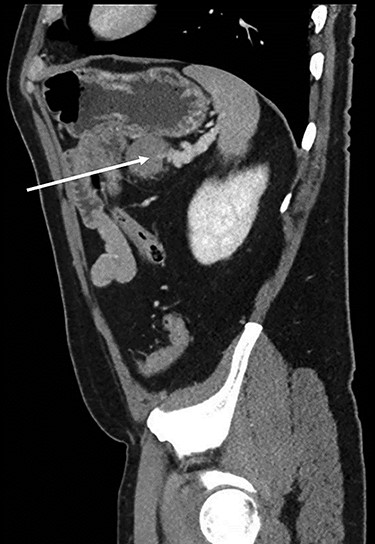 Sagital CT scan of abdomen, selected image from a pancreatic protocol, late arterial/pancreatic phase. A 3.7-cm mass, between the tail of the pancreas and the splenic hilum, causing a narrowing of the splenic vein and splenomegaly (arrow).
