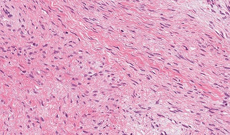 Microscopic study showing fusocellular proliferation with collagen-rich stroma, infiltrative in adipose tissue and pancreas (HE).