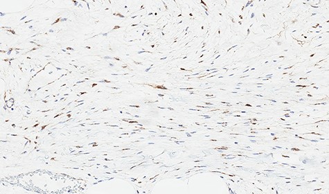 Immunohistochemical study showing positive nuclear expression for beta-catenin.