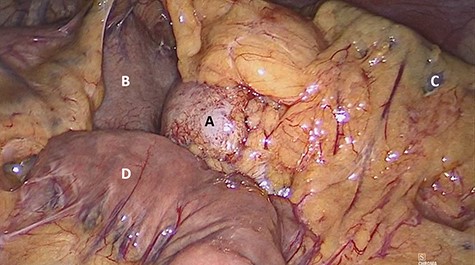 Laparoscopic view of (A) nodular lesion, (B) stomach, (C) spleen and (D) small intestine.