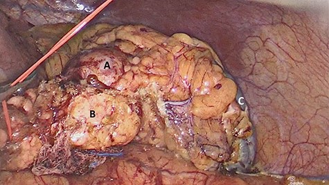 Laparoscopic view of (A) nodular lesion, (B) vessel loop encircling the pancreas and (C) spleen.