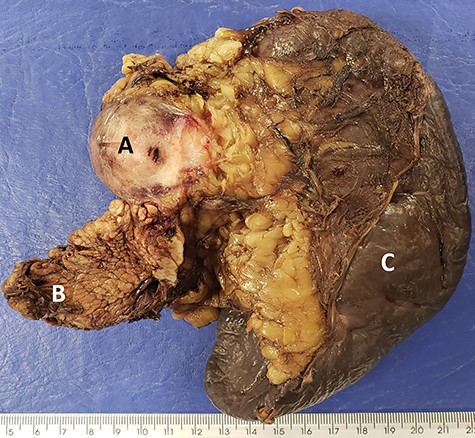 Macroscopic image showing firm and brown (A) nodular area, on the periphery of the (B) caudal region of the pancreas and (C) spleen.