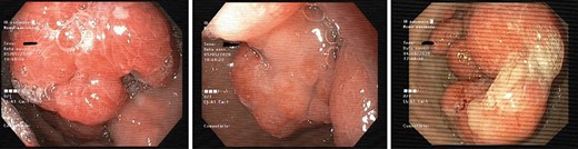 EGD image showing conglomerate of polyps in the antrum.