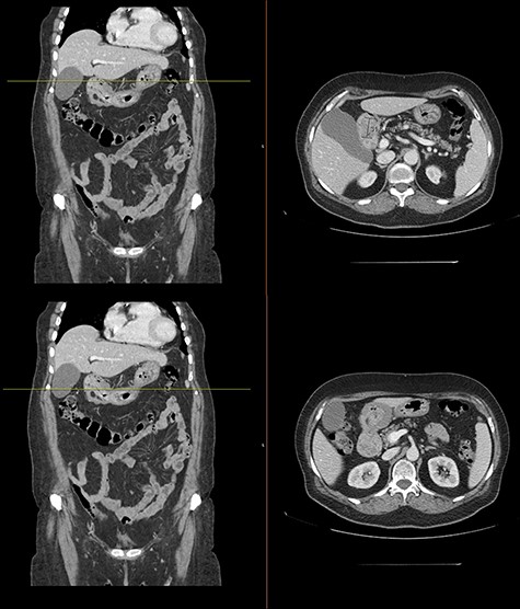 Computed tomography with intravenous contrast images demonstrating endoluminal expansive formations in the gastric antrum.