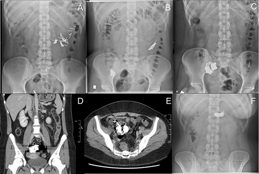 Radiographic series of sequentially ingested nails and magnets. The nails measured 2 cm long and magnets 2 cm in diameter and 0.75 cm in height. All dates are relative to initial ingestion of nails. (A) Day 1 – Nails in small bowel. (B) Day 6 – Additional ingestion of nails and a magnet. Original nails from A are clustered in right lower quadrant. (C) Day 9 – An additional four magnets have migrated to the right lower quadrant collection. (D) Day 15 – Coronal computer tomography (CT) view of nail-magnet collection in terminal ileum. (E) Day 15 – Axial CT view of nail-magnet collection in terminal ileum. (F) Day 26 – Smaller nail-magnet collection in transverse colon, 4 days after colonoscopic removal of the bulk of the collection.