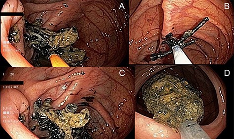 Endoscopic photographs of removal of nail-magnet collection from the terminal ileum. (A) Endoscopic forceps used to remove nails visible from the ileocecal valve (left of photograph). (B) Use of an endoscopic snare to remove additional nails from the ileocecal valve. (C) Collection of nails in cecum after their removal from the ileocecal valve. (D) Removal of the retrieved nails using a Roth Net® retrieval basket on colonoscopy withdrawal.