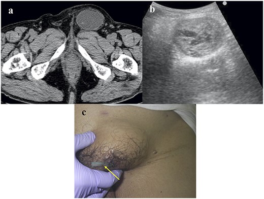 Images of the CEH. (a) Plain CT image. No hernia recurrence was observed and fluid collection was identified within the capsule. (b) Echography revealed a mosaic pattern. (c) A Penrose drain (arrow) was inserted into the CEH.