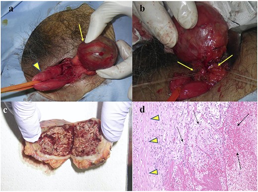 Intraoperative and pathological findings. (a) The CEH (arrow) was separated from the spermatic sheath (arrowhead). (b) The vessels (arrow) connected to the CEH were divided. (c) Cut surface of the resected specimen. (d). Hematoxylin–eosin staining of the CEH (×100). The specimen contained inflammatory cells (arrow), such as lymphocytes and macrophages, and the hematoma (dotted line) was capsulized with collagen fibers (arrowhead).