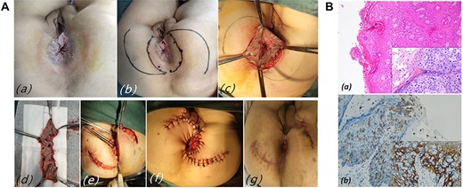 (A) Case 1: (a) oval erythematous perianal skin lesion with pale secretions, brownish pigmentation and surgical wound; (b) scout line determined by negative macroscopic margins > 1 cm (black); (c) wide excision with sphincter preservation; (d) surgical specimen; (e) skin flap transfer surgery; (f) Type S sutures the skin wound between the flaps after completion of surgery; (g) the incision was basically healed and the mucosa was slightly everted on postoperative Day 60. (B) HE stain and IHC in case 1. (a) Low and Higher power view show clusters of Paget cells with pleomorphic nuclei and pale cytoplasm in the epidermis (Inset HE×200). (b) Paget cells showing strong immunoreactivity for CK7.