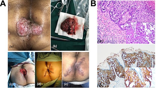 (A) Case 2: (a) well-defined pink butterfly-like patches interspersed with white secretions above the surrounding skin, and its size was 4 × 5 cm; (b) surgical specimen; (c) mapping of the incision for skin flap; (d) after completion of the wide local excision of PPD plus skin flap transfer surgery; (e) the incision was basically healed, nevertheless the reconstructed anal is relatively narrow on postoperative Day 60. (B) HE stain and IHC in Case 2; (a) clusters of cells with pleomorphic nuclei and pale cytoplasm in the epidermis (inset HE × 200); (b) Paget cells showing strong immunoreactivity for CK5/6.