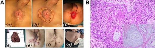 (A) Case 3: (a and b) skin induration around the anus, and scout line determined by negative macroscopic margins > 1 cm; (c) wide excision with sphincter preservation; (d) surgical specimen; (e) after completion of Miles surgery; (f and g) the incision was basically healed on postoperative Day 60. (B) Pathological findings of PPD and mucinous adenocarcinoma: mucinous adenocarcinoma cells with a lot of mucus and pleomorphic nuclei in the center of picture, Paget cell with pleomorphic nuclei and pale cytoplasm.