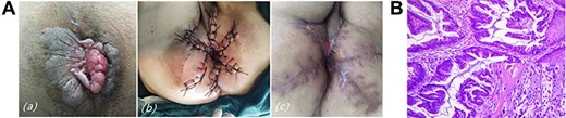 (A) Case 4: (a) clinical findings: a bleeding lump prolapsed out of anus, abnormal skin lesions around it; (b) after completion of the wide local excision of PPD plus skin flap transfer surgery; (c) the incision was basically healed on postoperative Day 60. (B) Pathological findings of PPD and tubular adenocarcinoma: Paget cell with pleomorphic nuclei and pale cytoplasm, and tubular adenocarcinoma with branched conduits.