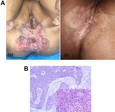 (A) Case 5: (a) examination of perineal regions with well-defined irregular infiltrating erythema easy to notice; (b) perianal local skin lesions were improved after 30 radiotherapy sessions. (B) Pathological findings of PPD in left inguinal lymph node: Paget cell with pleomorphic nuclei and pale cytoplasm.