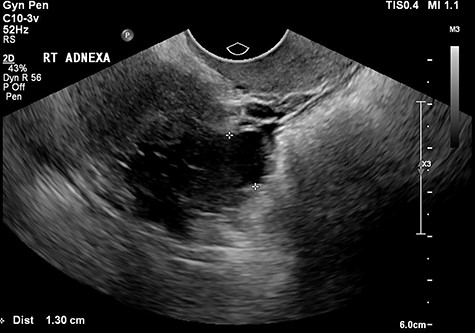 The tertiary ultrasound of the right adnexa demonstrating the 33 mm × 18 mm × 34 mm serpiginous cystic structure with a 13-mm lumen consistent with a hydrosalpinx.