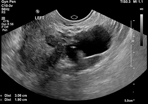 The tertiary ultrasound of the left adnexa demonstrating a 30 mm × 19 mm × 27 mm cystic structure with incomplete septae in keeping with a possible hydrosalpinx.
