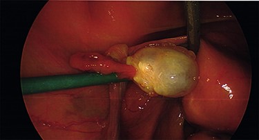 The intra-operative photos demonstrating the cystic appearance of the left ovary.
