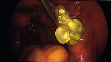 The intra-operative photos demonstrating multiple cystic structures covering the surface of the right ovary.