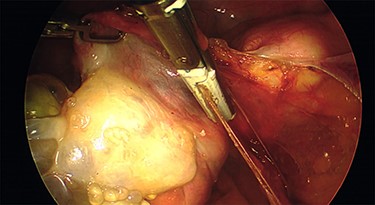 The intra-operative photographs of the posterior aspect of the right ovary.