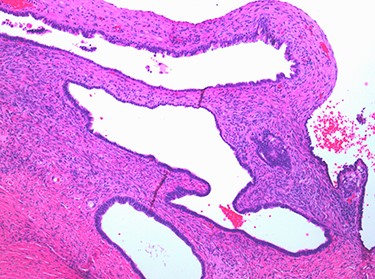 Multiple cysts of variable diameter lined by a single layer of epithelium, separated by ovarian stroma; haematoxylin and eosin stain, medium magnification, scale ×10.