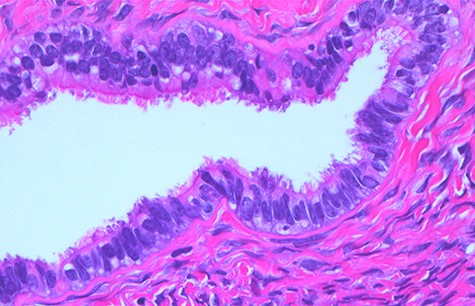 Normal serous epithelium with prominent delicate cilia lining the cyst lumen; haematoxylin and eosin stain, high magnification, scale ×40.