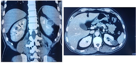 CT showing a heterogeneous Bosniak type-3 cystic mass having a thickened wall.