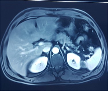 MRI showing left polar cyst having an exophytic development and a thickened wall with spontaneous T2 hypo-intensity and T1 hyperintensity.