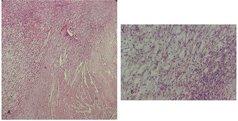 histological examination. (A) Hematoxylin Eosin × 20: inflammatory granulomatous changes in contact with cholesterol crystals. (B) Hematoxylin Eosin × 40: inflammatory infiltrate rich in xanthemous foam cells.