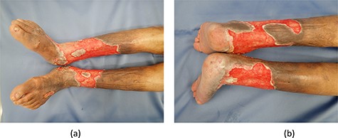 (a) Front side of both limbs. (b) Back side of both limbs.