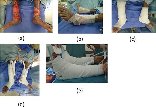 (a) Meshed skin grafts fixed to the wound beds. (b) Meshed skin grafts were covered with silicon gauze. (c) Gauze filler was rolled around several times. (d) Covered with waterproof films and attached Y-connector. (e) Whole legs were fixed with splints.