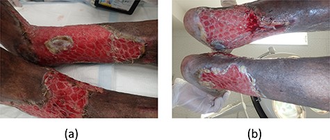 (a, b) All meshed skin grafts took.