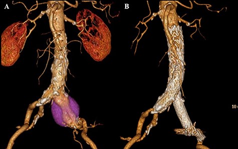 CT scan showing left CIAA (A). Contrast-enhanced CT demonstrating no endoleak after EVAR using a GORE EXCLUDER AAA Endoprosthesis to embolize the left internal iliac artery (B).