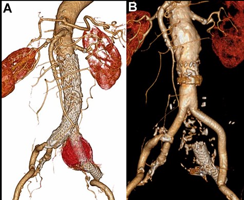 CT scan showing the increasing sac size of left CIAA with no endoleak (A) and aortic replacement with a Y-shaped vascular prosthesis performed with complete explantation of the endograft (B).