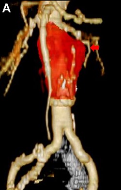 CT scan showing the significantly dilated infrarenal aorta, 1 year after open conversion (A, red arrow).