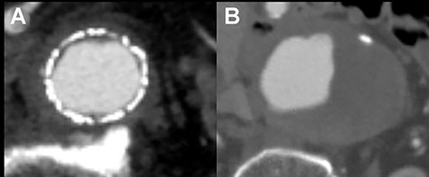 One year after open conversion, CT scan showing the significantly dilated infrarenal aorta (A) compared with the aorta before open repair (B).