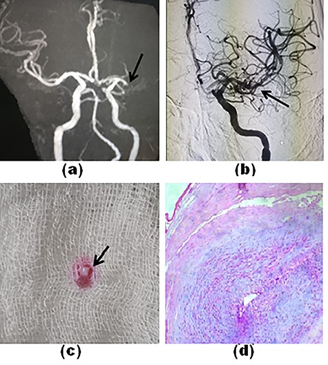 Time-of-flight MR angiography shows a complete cut-off of left M1-MCA (a, arrow). The final angiogram shows complete recanalization of the MCA and its branches (b, arrow). The tissue thrombus resembled an organic tissue (c). Histopathology of the tissue thrombus shows parallel bundles of muscle fiber (d).