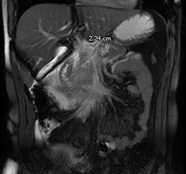 MRI demonstrating acute pancreatitis and a 2.24 cm IPMN.