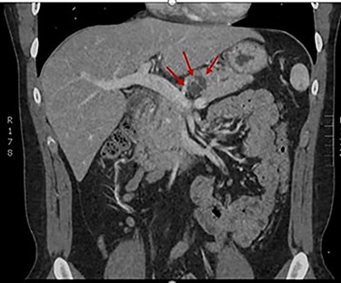 CT demonstrating resolution of pancreatitis and interval growth of IPMN to 2.4 cm.