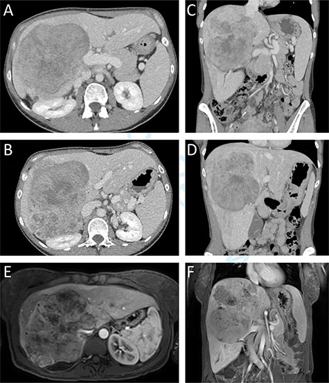 Preoperative CT and MR imaging. Axial (A + B) and coronal (C + D) CT images depicting a large mass replacing the right liver lobe, involving the retrohepratic IVC and compressing the right kidney. The portal bifurcation is free of tumour and the left portal vein is patent. (E + F) MR images depicting the large lesion occupying the right liver lobe and involving the retrohepatic IVC.