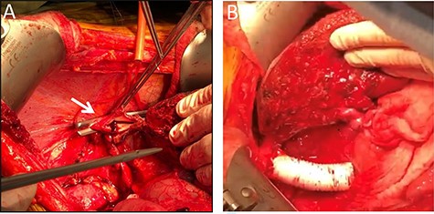 Intraoperative images. Intraoperative image depicting the remnant left lateral segment drained by the left hepatic vein into the IVC stump, marked by an arrow (A), and following IVC reconstruction with Gore-tex graft (B).