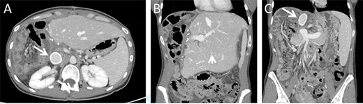 Postoperative CT imaging. (A) Axial CT image depicting patent IVC graft (arrow). (B + C) Coronal images depicting hypertrophied remnant liver (arrowhead), patent portal vein and IVC graft (arrow).